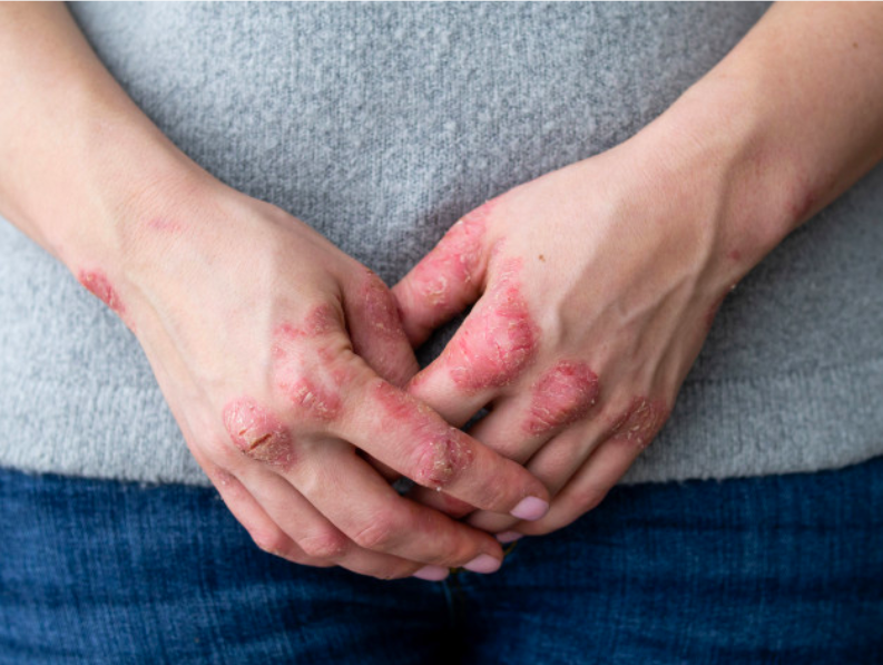  Psoriasis  Penyakit  Autoimun di Kulit  yang Menyerang Organ 